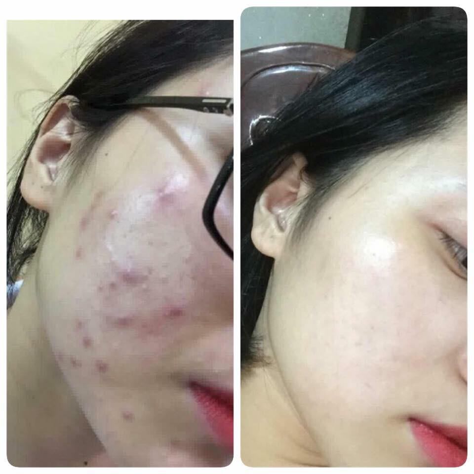 Soo Young Korea High Quality Acne Cream Skin Care Treatment Set