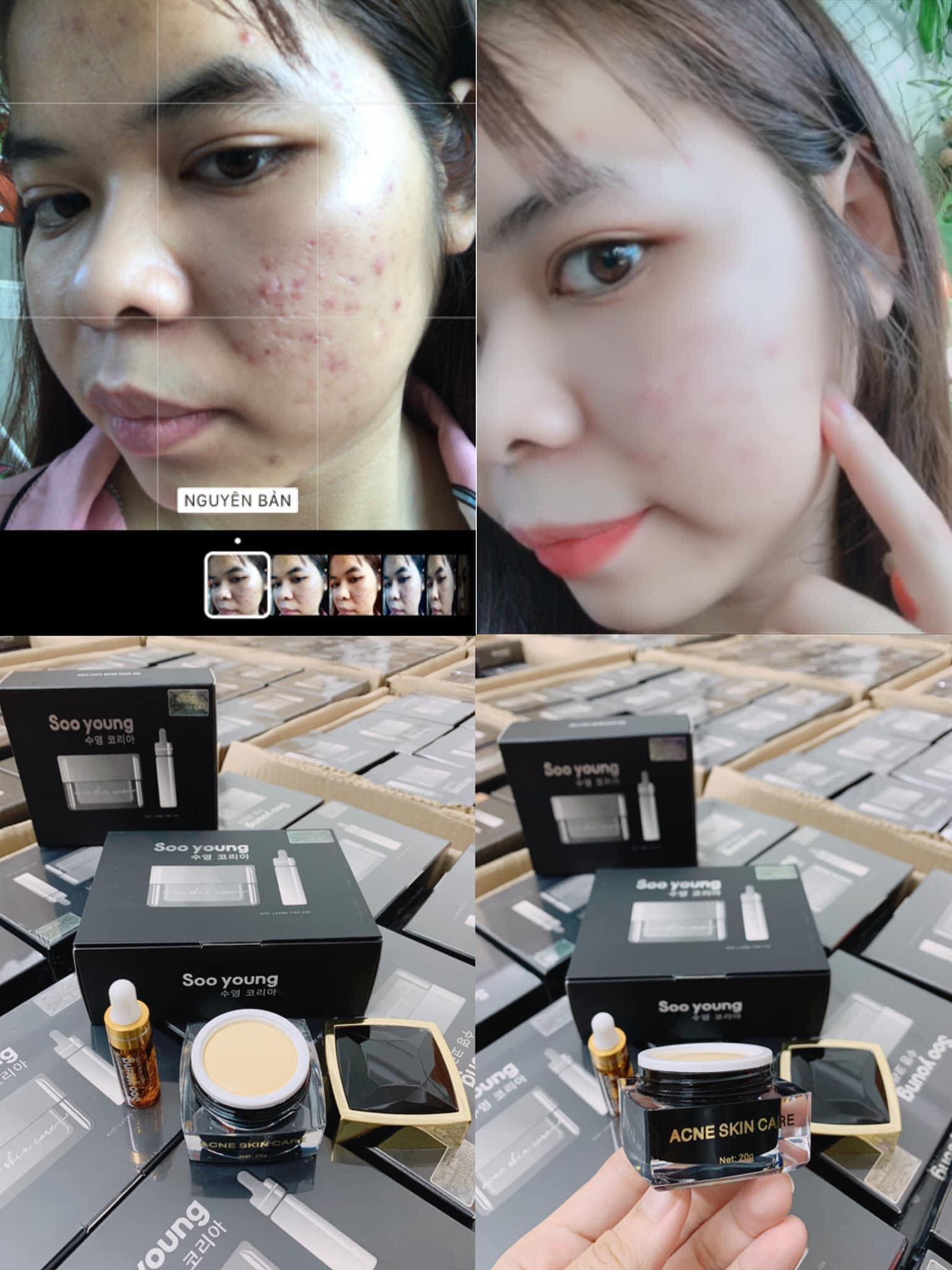 Soo Young Korea High Quality Acne Cream Skin Care Treatment Set